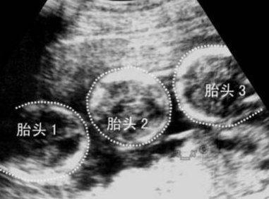 哈尔滨第三代试管费用大概需要多少？